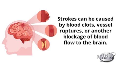 Life After Stroke Strokes And Catheters 180 Medical