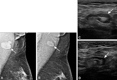 Axillary Lymphadenopathy In The Covid 19 Era What The Radiologist