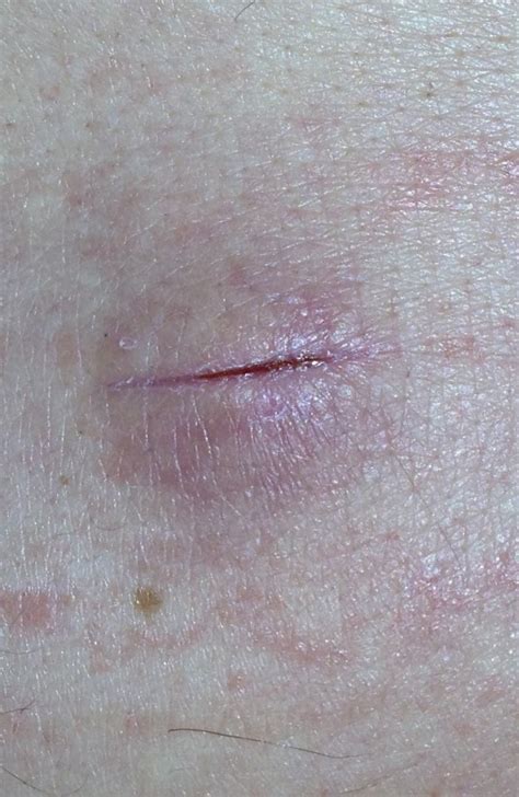 Abscess Incision And Drainage A Photographic Tutorial Jail Medicine