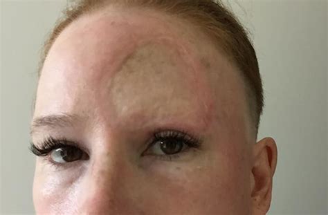 Mum Shares Graphic Surgery Recovery Pictures After Being Diagnosed With