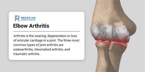 Elbow Arthritis Njs Top Orthopedic Spine And Pain Management Center