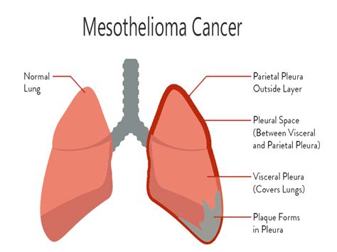 Mesothelioma Cancer What Is It Doctor Heck