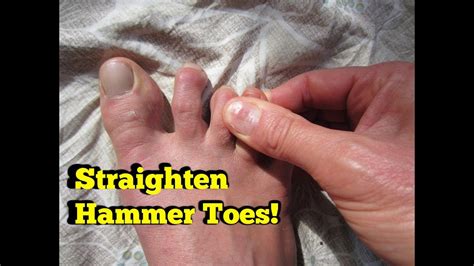 Natural Cure For Hammer Toes Claw Or Mallet Toes Youtube
