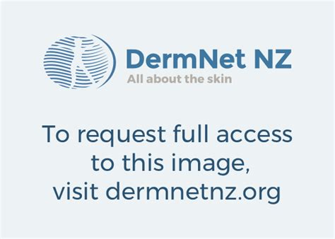 Impetigo Dermnet New Zealand