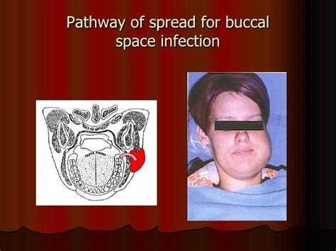 Spread Of Oral Infections
