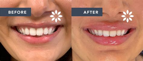 Lip Injections Before & After 1211919 - 8 West Clinic Vancouver