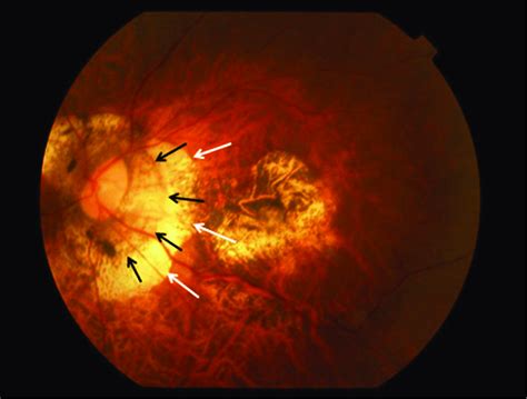 Fundus Photograph Of A Highly Myopic Eye With Parapapillary Delta Zone