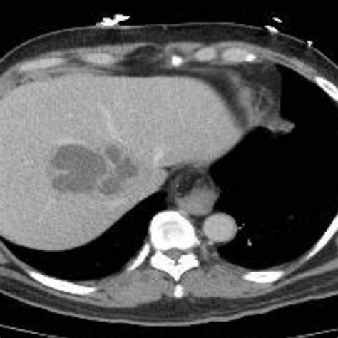 Ct Of Abdomen And Pelvis With Iv Contrast Showing A 55 X 89 X 98 Cm