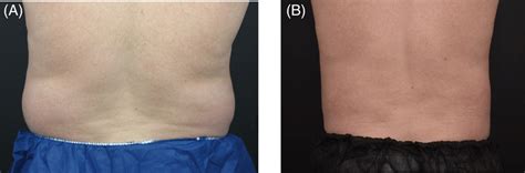 Coolsculpting Of The Flanks A A 42‐year‐old Woman Before Treatment