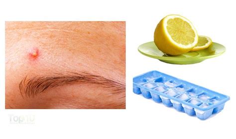 How To Get Rid Of Pimples Fast Top 10 Home Remedies