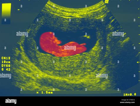 Ultrasound Biometry Of The Fetus Stock Photo Alamy