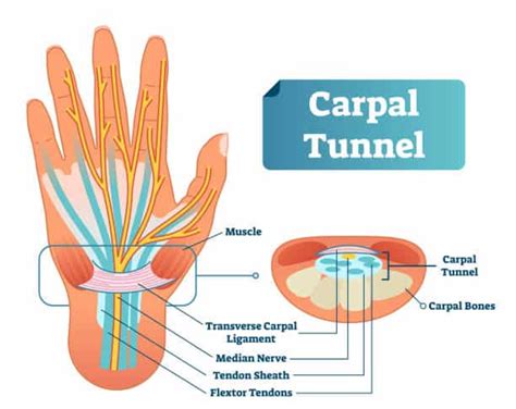 Carpal Tunnel Syndrome Treatment Knoxville Spine And Sports