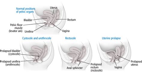 See more ideas about prolapsed uterus, uterus, pelvic floor. What's Up Down There? : November 2012