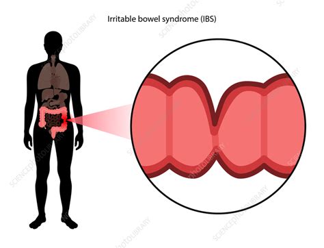 Irritable Bowel Syndrome Illustration Stock Image F036 1473