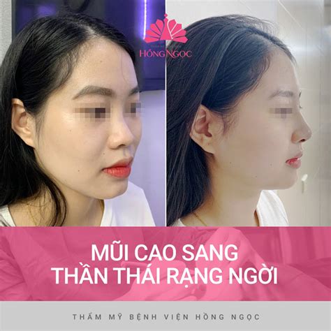 Top Hơn 27 Bài Viết Cách Làm Sống Mũi Cao Vừa Cập Nhật Vn