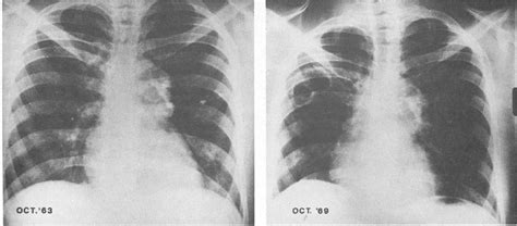 In The Chest X Ray Of October 1963 Large Calcific Aggregates Are Seen