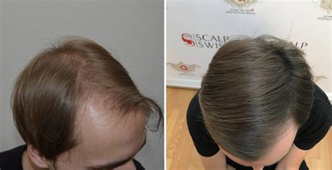 Scalp Mp For Men