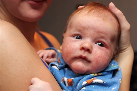 Baby Has Eczema On His Face Health Begins With Mom