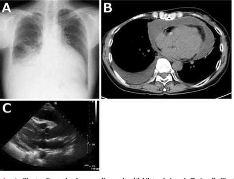 Figure 1 From The Antemortem Diagnosis Of Primary Malignant Pericardial