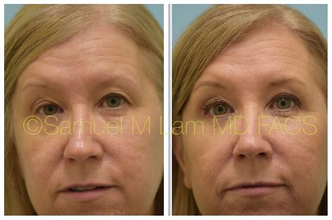Upper Eyelid Surgery Before And After Upper Eyelid