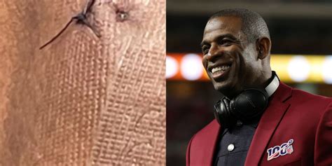 Deion Sanders Shares Gruesome Photo Of His Foot After Surgery Pic