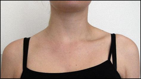 Transient Unilateral Neck Swelling After Unusual Exertion The American Journal Of Medicine