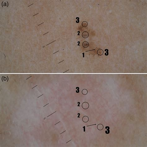 A Dermoscopic Features Of Pigmented Superficial Basal Cell Carcinoma