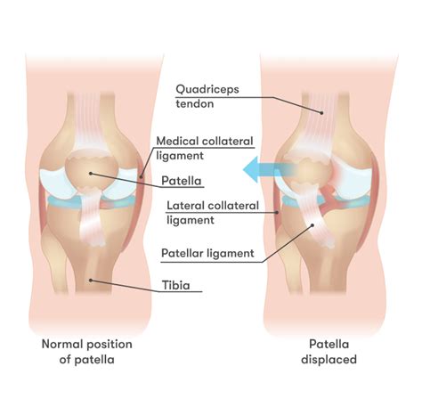 Why Does My Knee Hurt? 10 Common Sources of Knee Pain