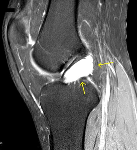 Ganglion Cyst Of Acl Mri Sumers Radiology Blog
