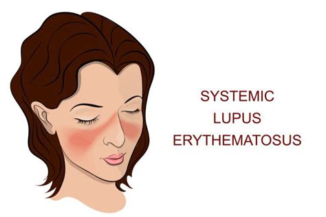 Systemic Lupus Erythematosus Corpus Christi Tx Arthritis