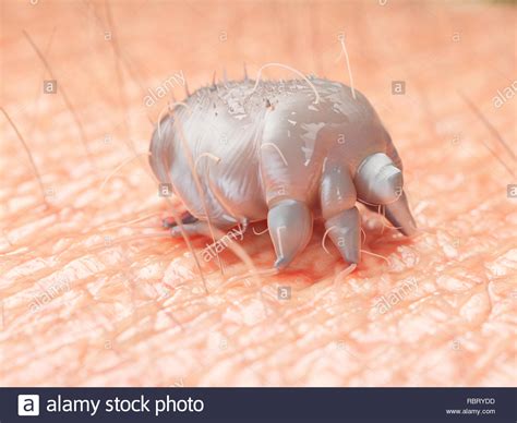 Illustration Of A Scabies Mite On Human Skin Stock Photo Alamy