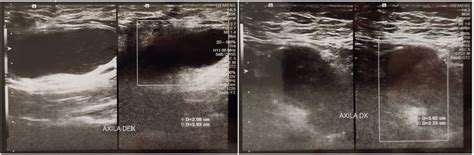 Ultrasonography Examination Showed Multiple Lymphadenopathies