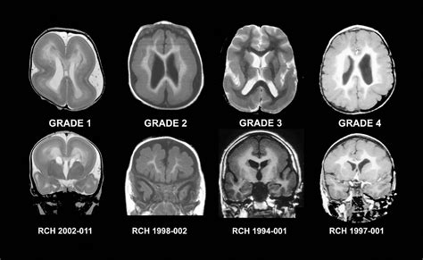 Icd 10 Abnormal Mri Brain Brainlyzi