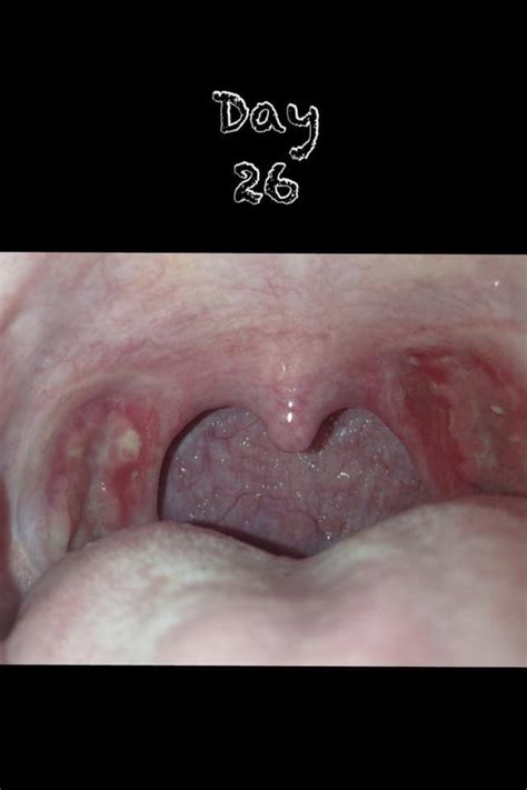 Tonsillectomy Recovery Photos Tonsillectomy Vrogue Co