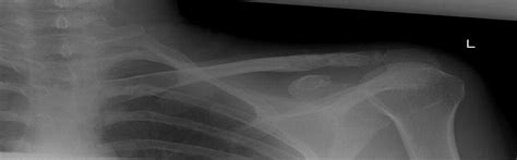 Clavicle Hook Plate Fixation For Displaced Lateral Third Clavicle