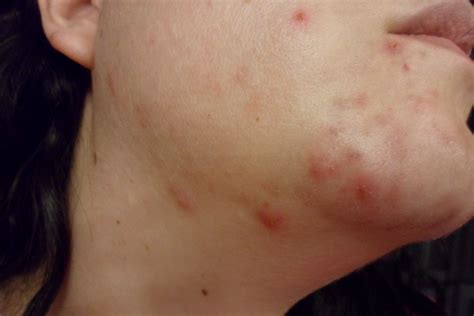 Itchy Spots On The Skin Does Acne Itch Acnetreatment