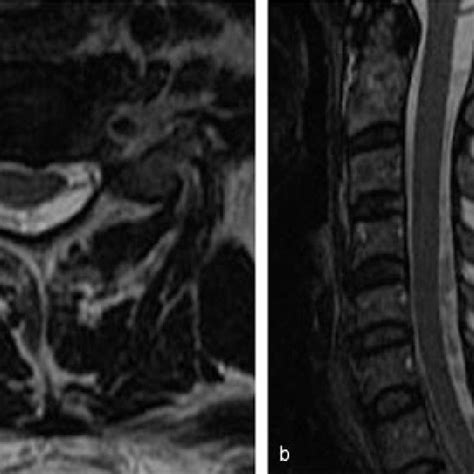 A Axial T2 Weighted Mri Of The Cervical Spine Showing An Intradural