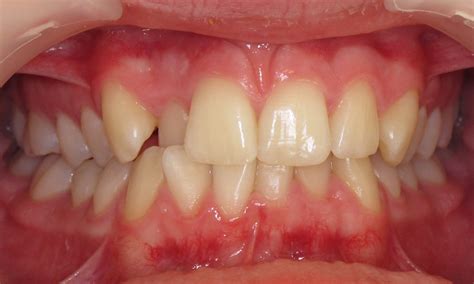 Quick Straight Teeth Whitegates Dental Clinic