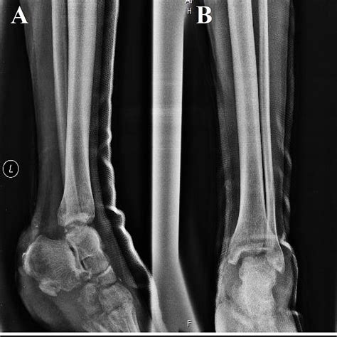 Cureus Management Of Heel Pad Degloving Injury After Severe Foot