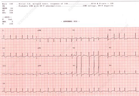 Ecg With Atrial Fibrillation