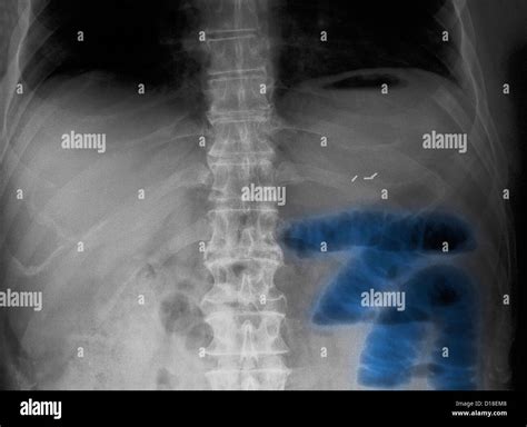 Abdominal X Ray Small Bowel Obstruction Stock Photo Alamy