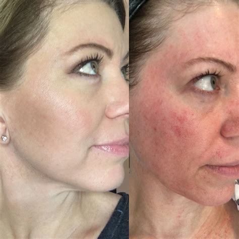 Microneedling Before And After Womens Blog Talk