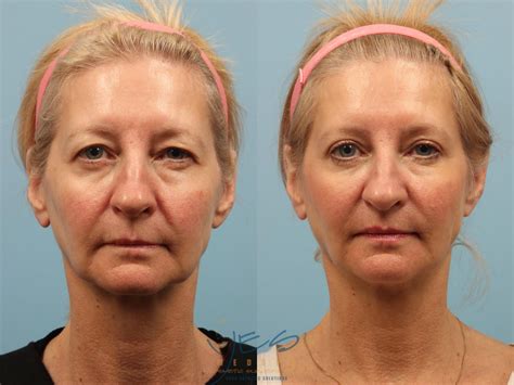Brow Lift Before And After Photo Gallery Vancouver Bc Yes Medspa