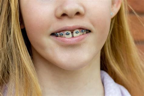Close Up Of A Teenage Girl Wearing Metal Braces Orthodontic Dental Braces Teeth Straighteners