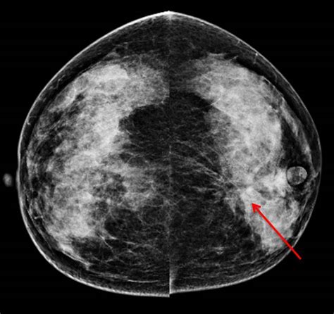 Mammography Pleomorphic Microcalcifications Radiology Cases