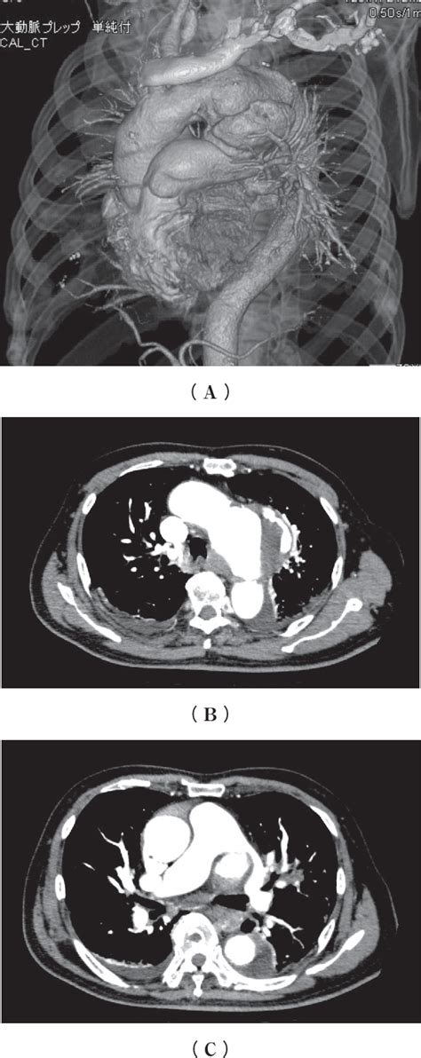 Figure 1 From Thoracic Endovascular Aortic Repair For Aortopulmonary