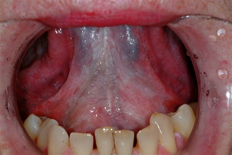 What Does Floor Of Mouth Cancer Look Like Viewfloor Co