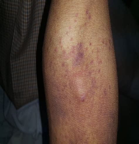 Violet Brownish Cutaneous Petechiae And Purpura On The Right Hand