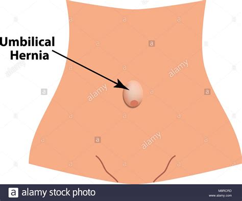 Stomach Hernia Illustration Stock Vector Images Alamy