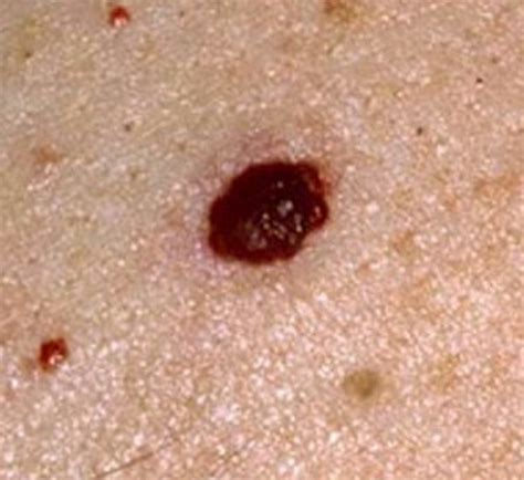While cherry angioma home remedies may not completely remove a cherry angioma, they may help shrink them. Cherry Angioma - Causes, Pictures, Diagnosis, Treatment ...